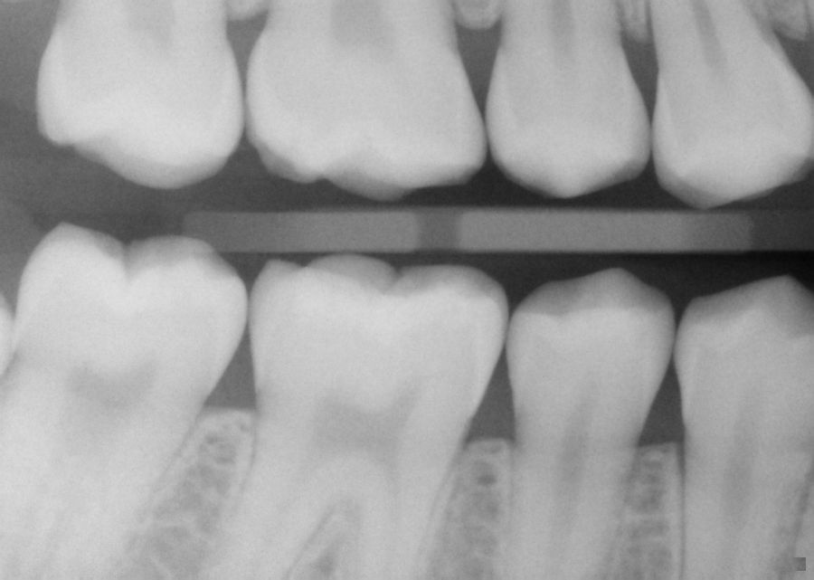 with pictures and xrays] Has the abscesses done any teeth