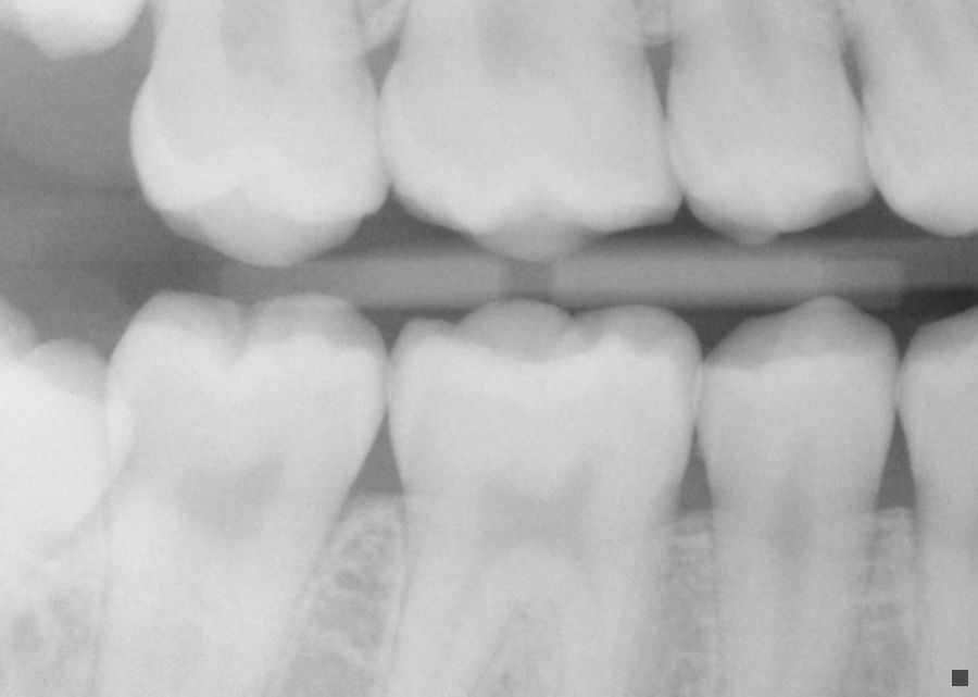 with pictures and xrays] Has the abscesses done any teeth