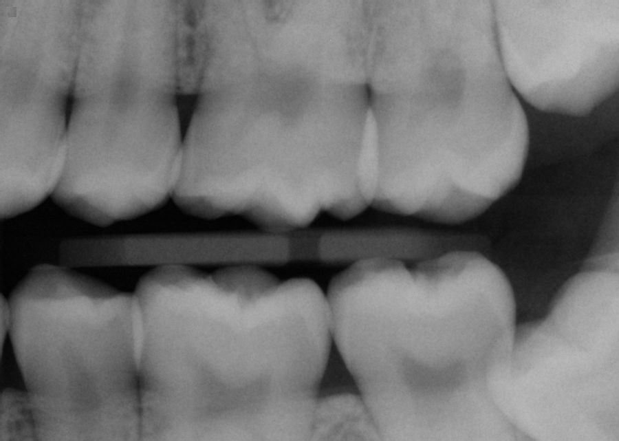 with pictures and xrays] Has the abscesses done any teeth